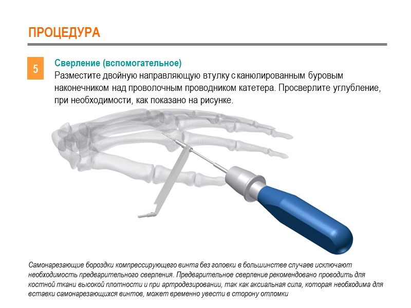 ПРОЦЕДУРА 5 Сверление (вспомогательное) Разместите двойную направляющую втулку с канюлированным буровым наконечником над проволочным
